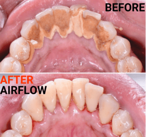 Airflow EMS teeth cleaning GBT
