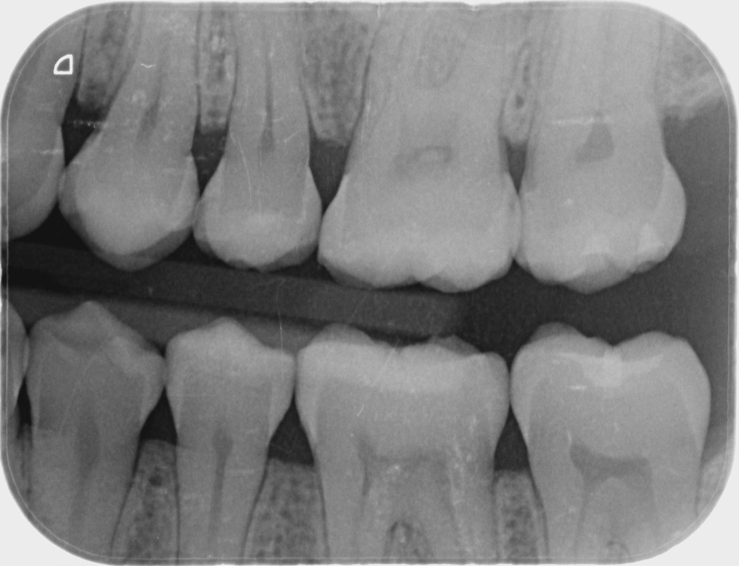 Dental x-rays at the dentist