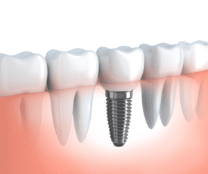 dental Implants Brisabne