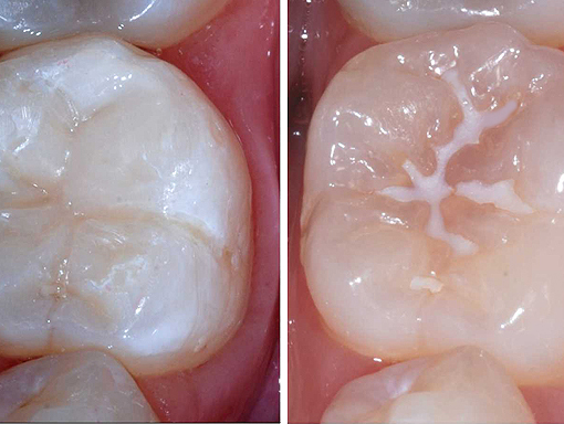 benefits of Fissure SealantsFissure Sealants