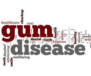 Gum Disease- causes, symptoms and prevention