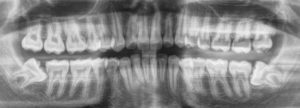 wisdom teeth removal