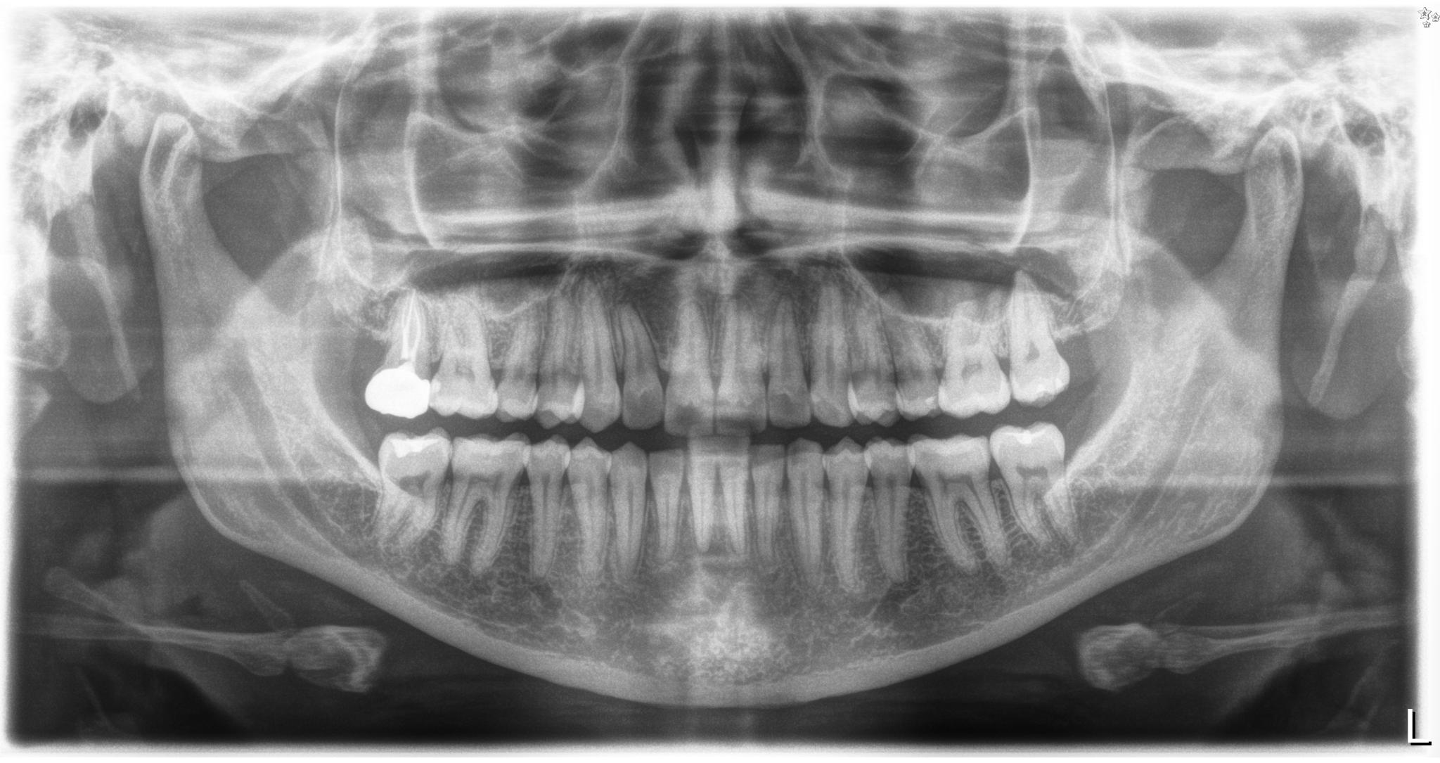 Dental X-rays 