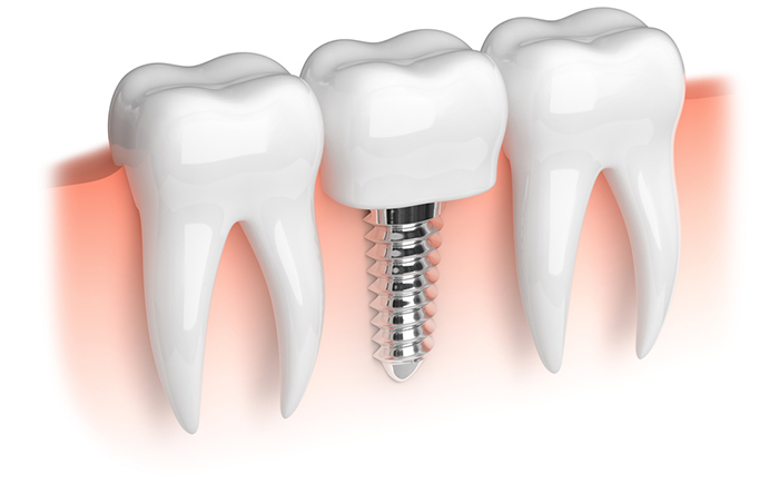 Dental Implants indooroopilly