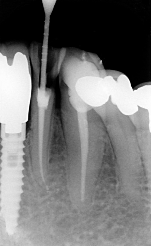 Root Canal Treatment