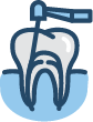 Root canal treatment Indooroopilly